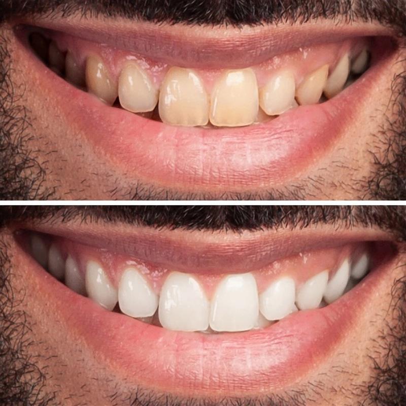 woman-teeth-before-after