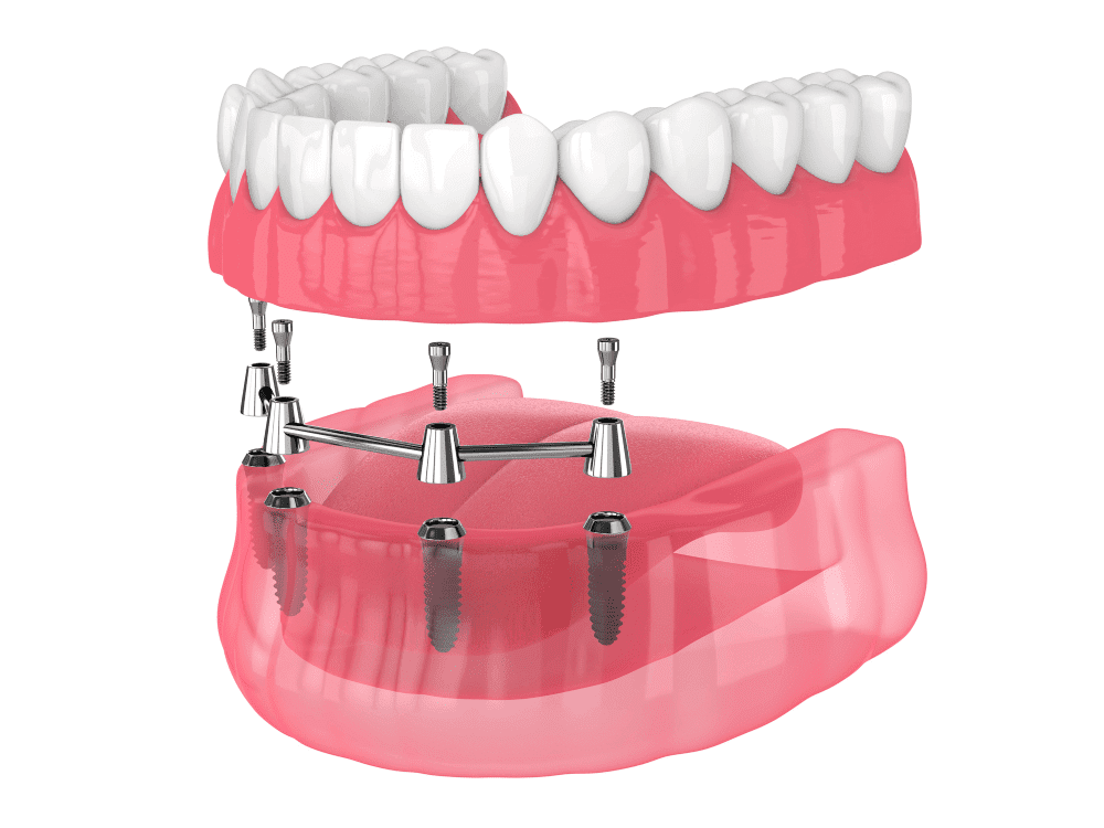 All-On-4-Dental-Implants