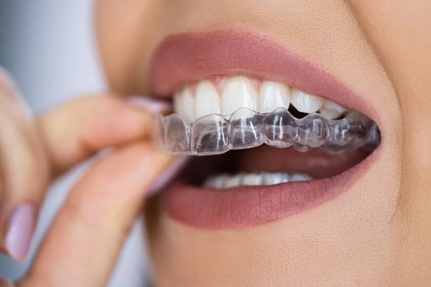 invsialign retainers