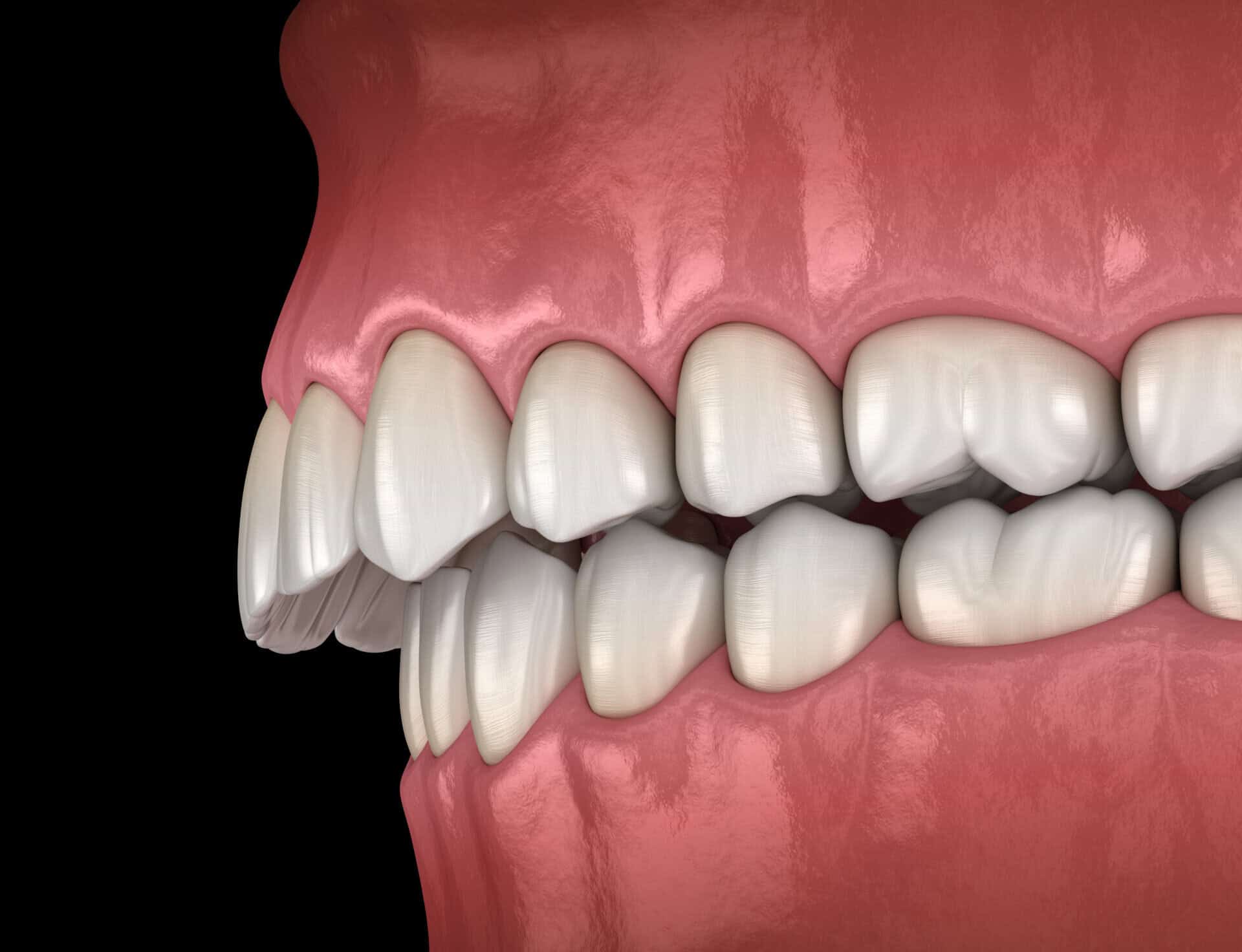 bite correction