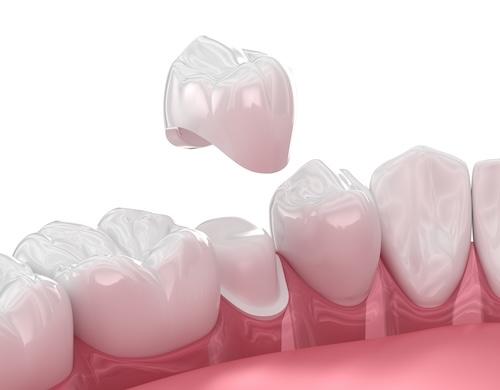 crown-on-tooth1