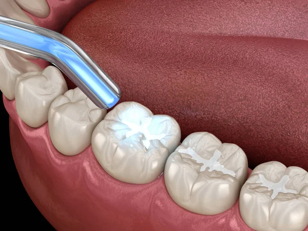 dental fillings 2