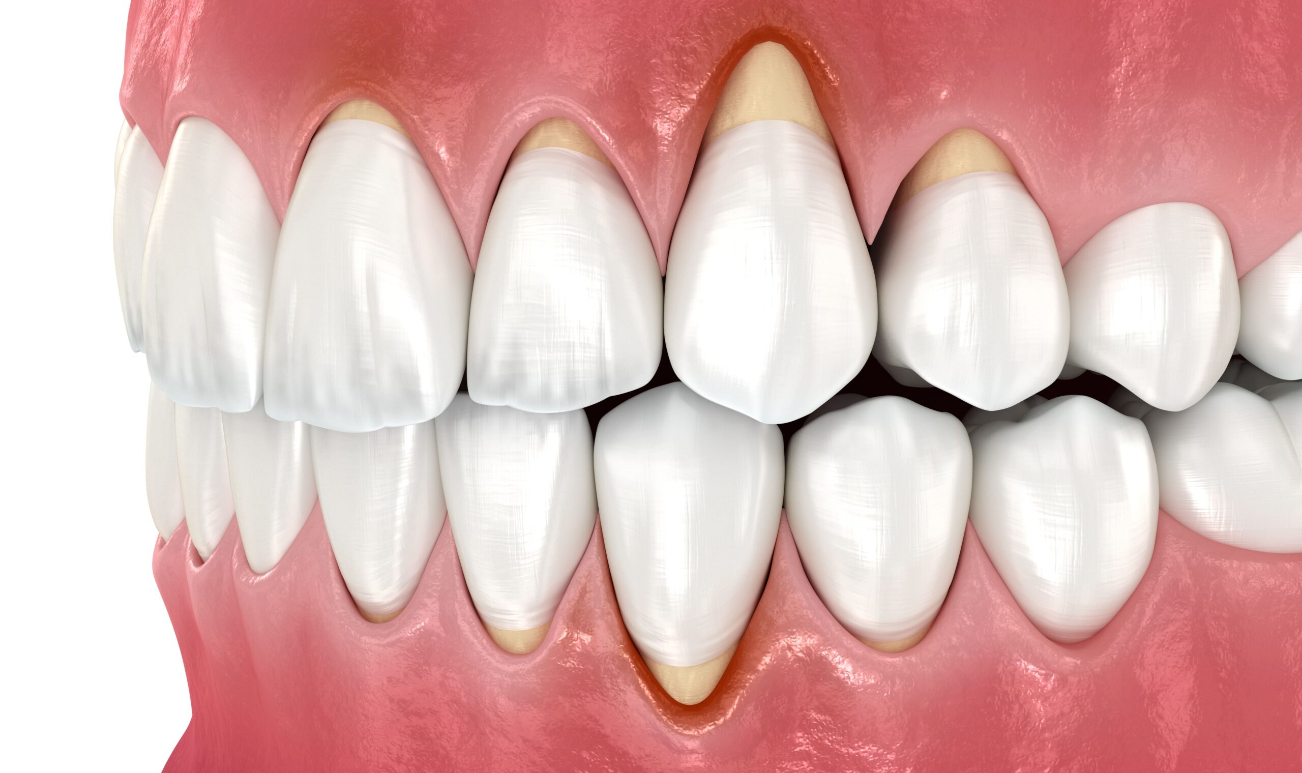 gum recession