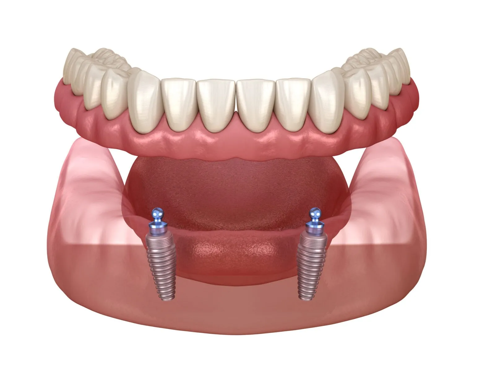 implant supported dentures