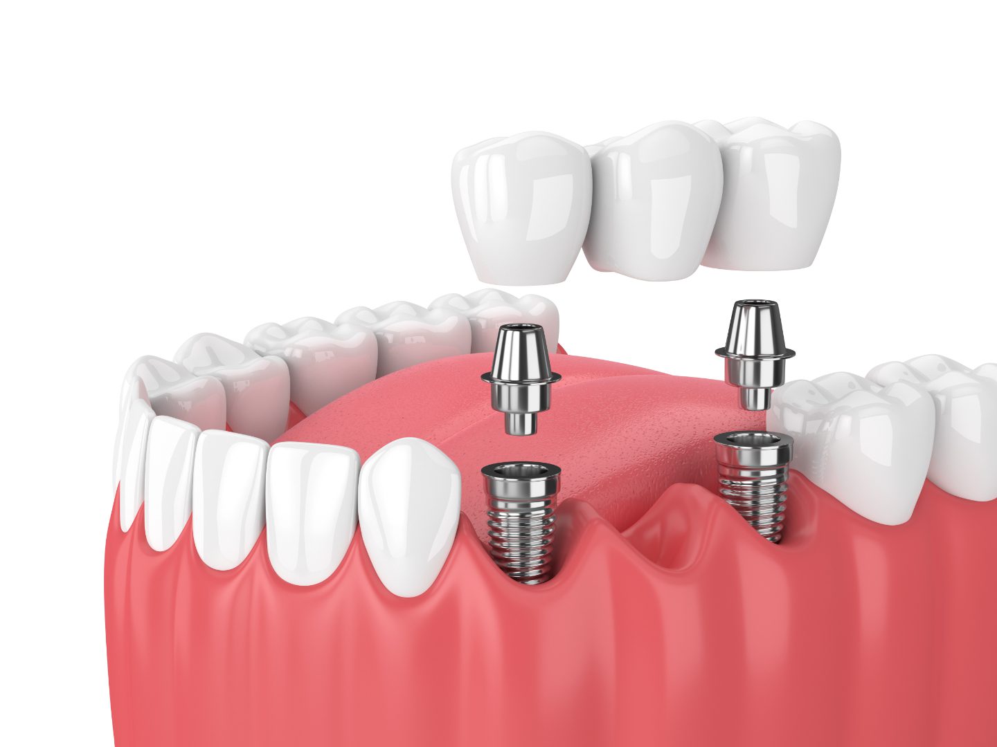 multiple implants