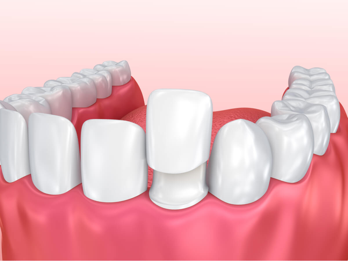no prep veneers