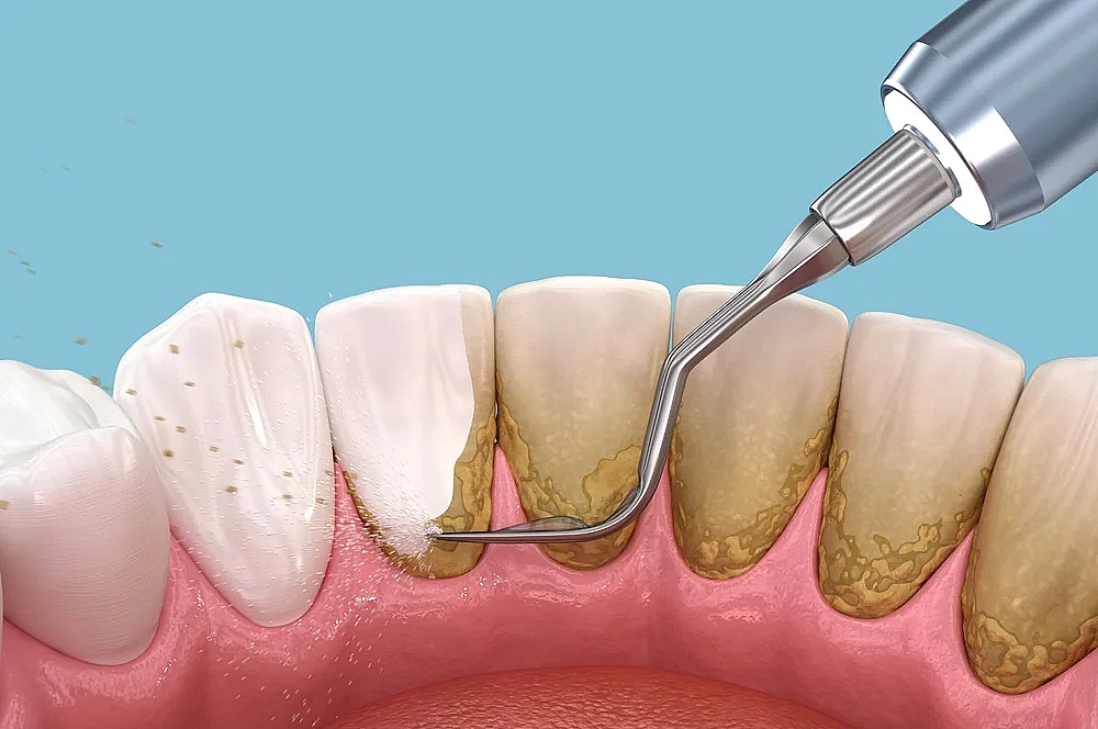 periodontal maintenance