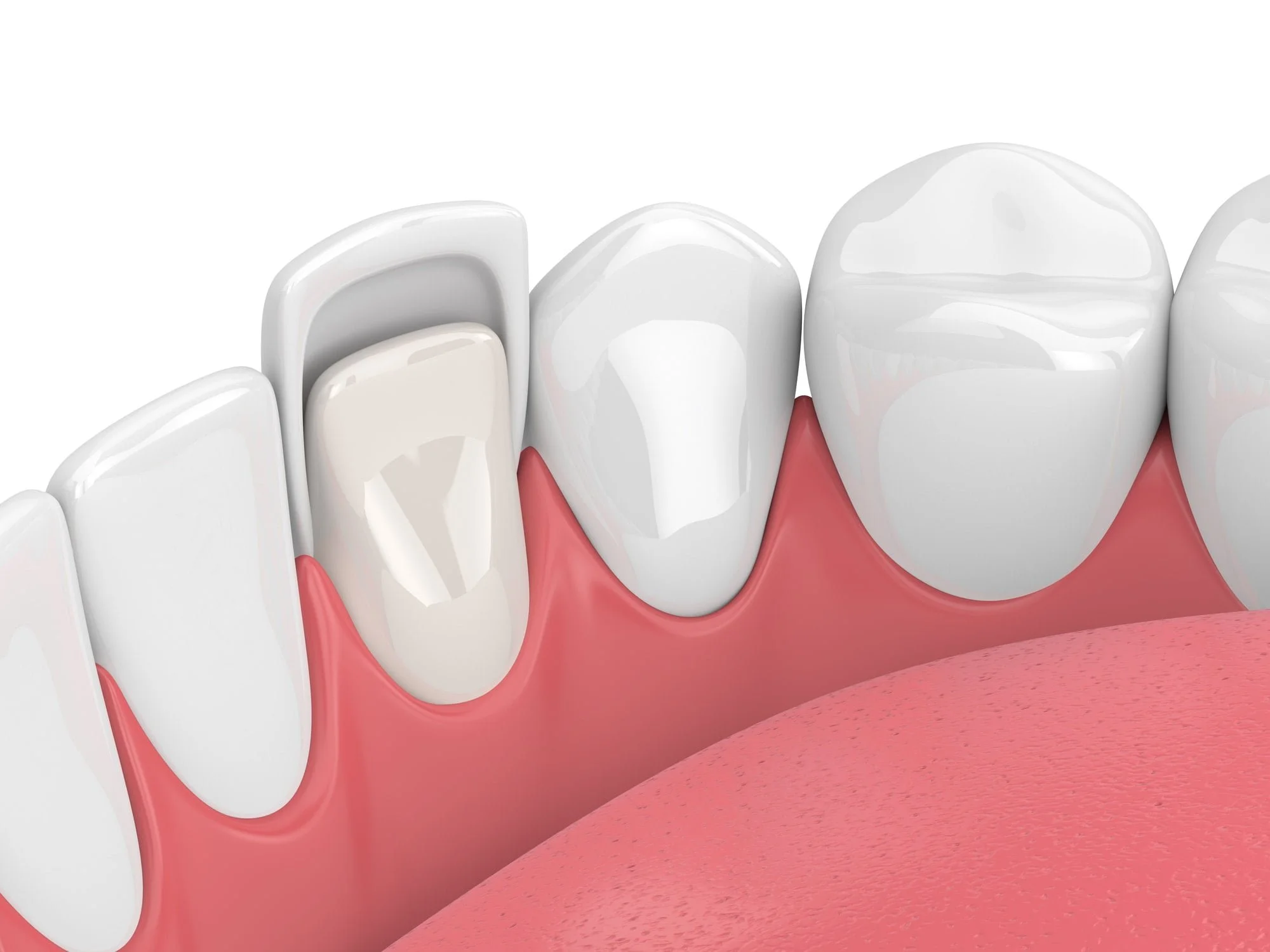 porcelain veneers