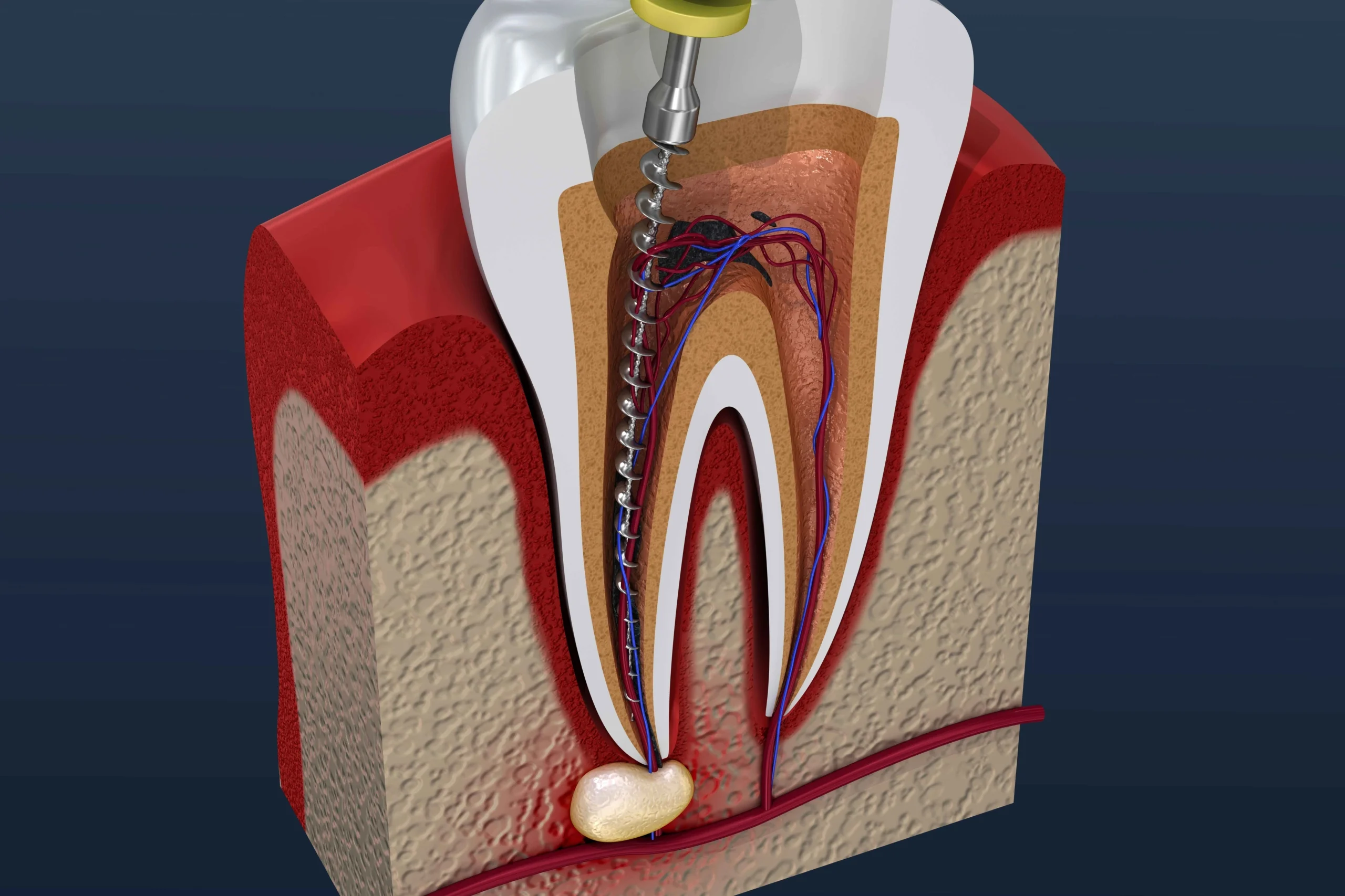 re-root canal