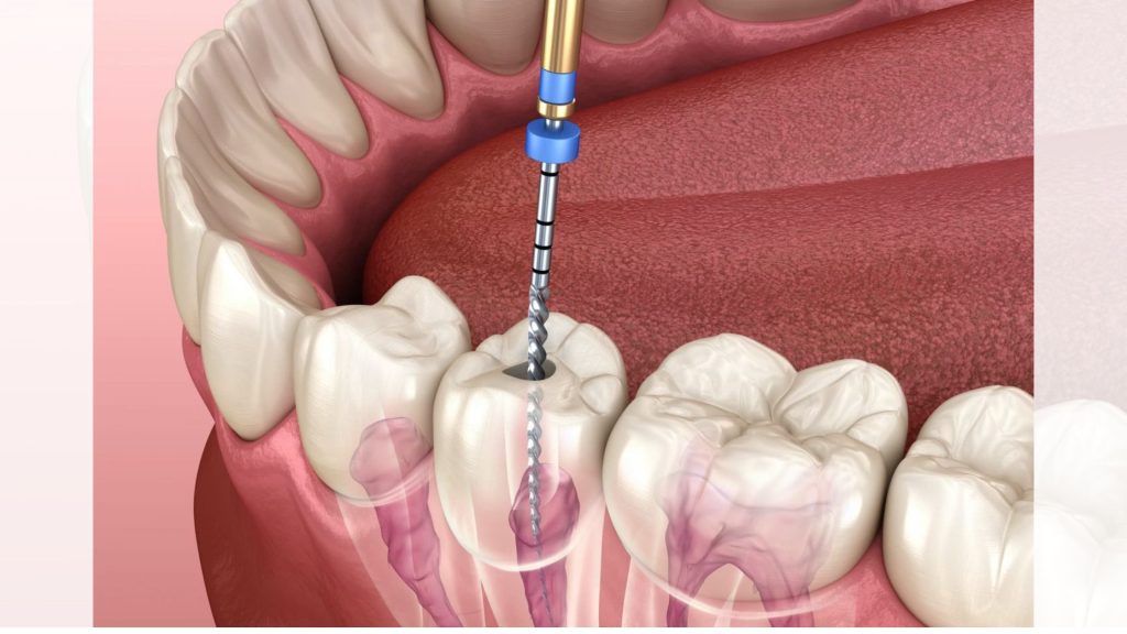 root canal