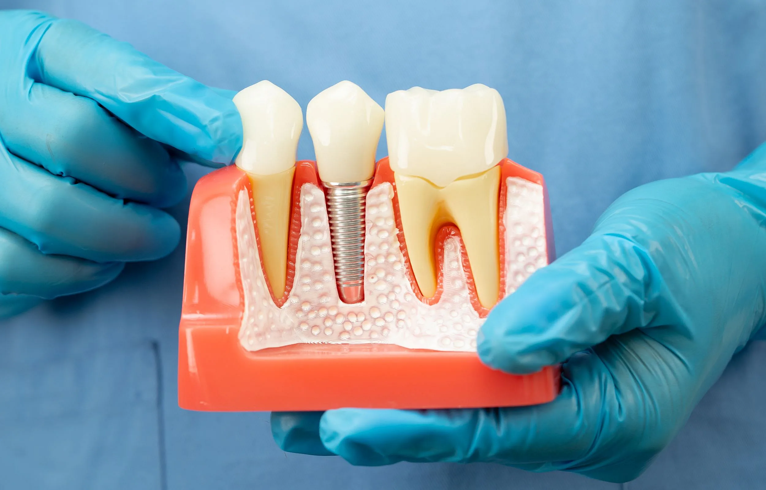 single tooth implant