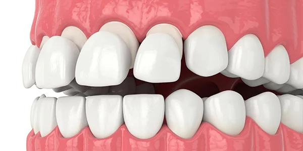 smile makeover
