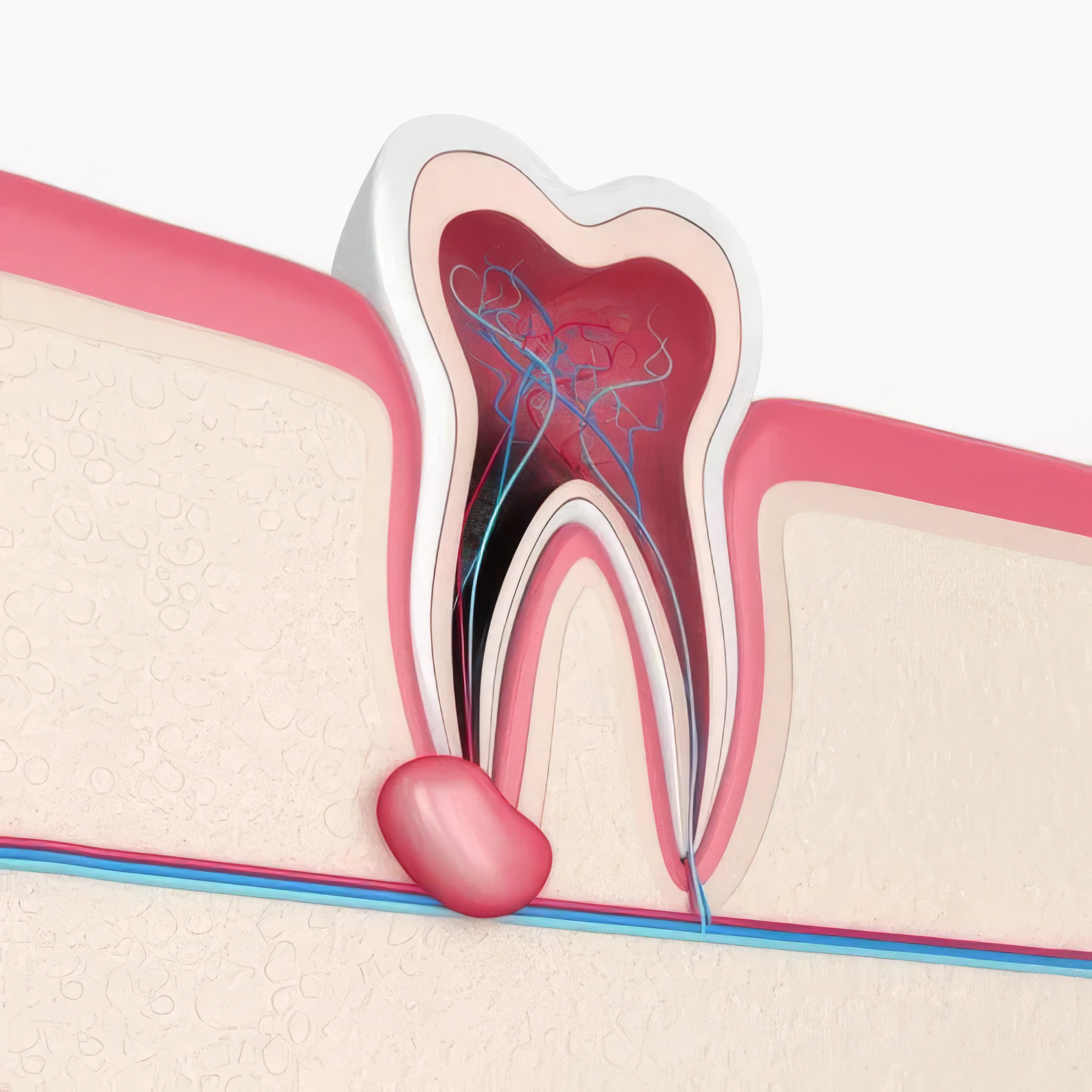 tooth abscess