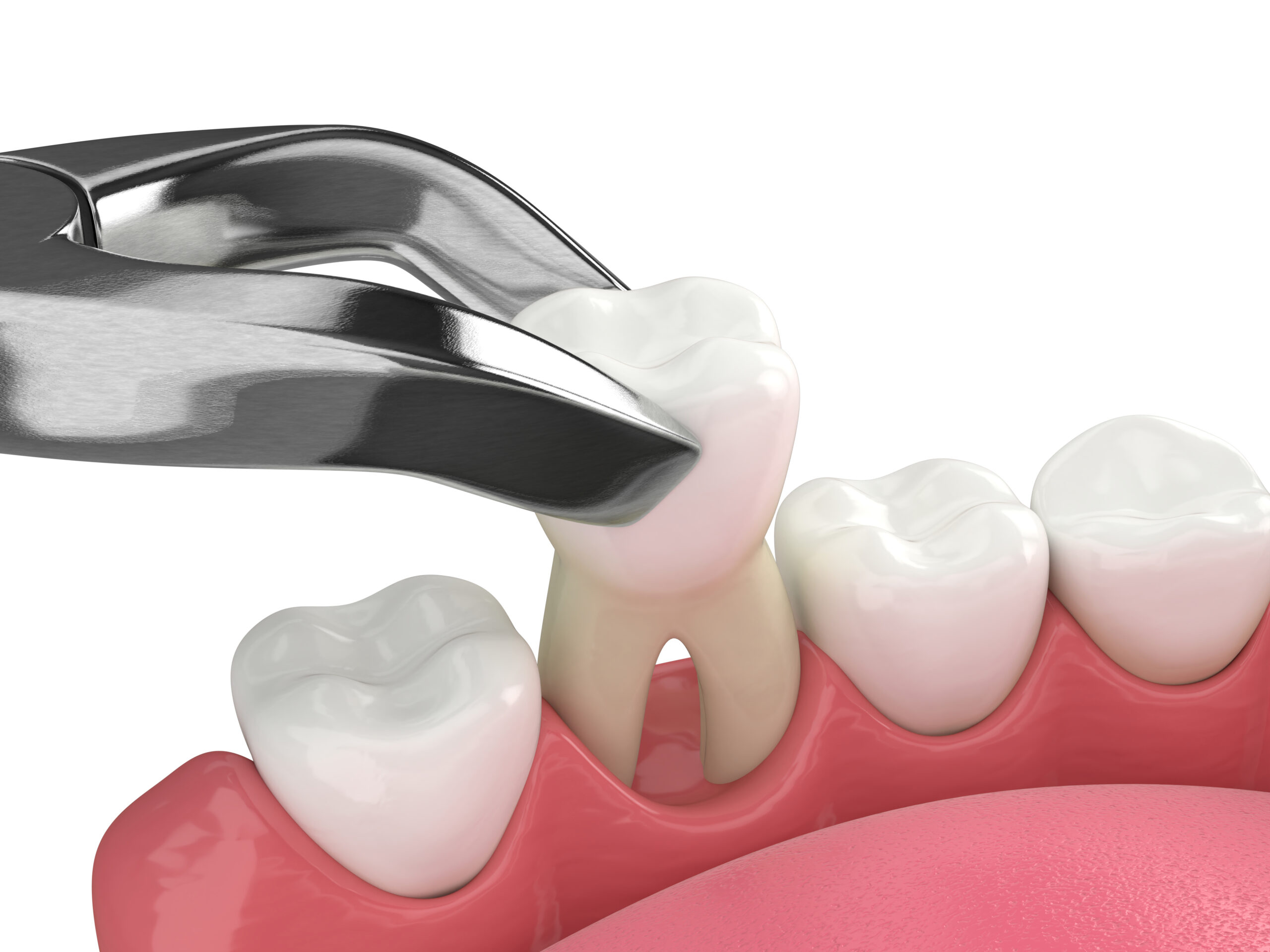 tooth extraction