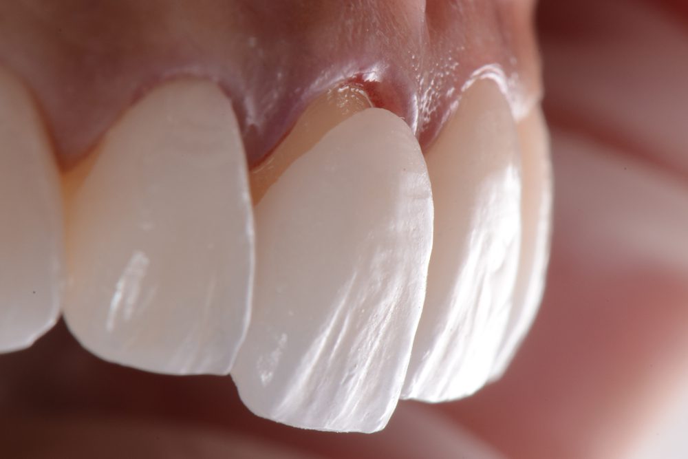 veneers